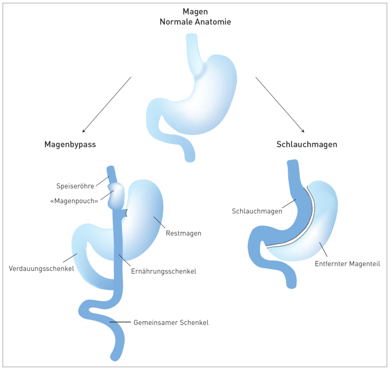 Schematische Darstellung der bariatrischen Eingriffe (Magenbypass, Schlauchmagen)